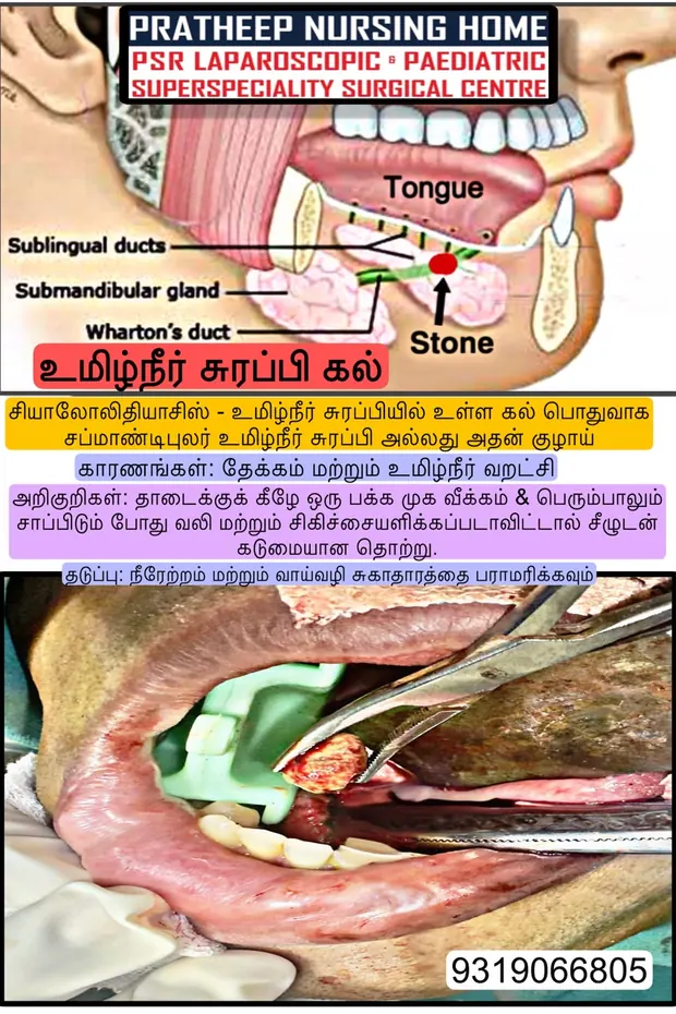 Clinical photograph of a salivary stone removed from the mouth