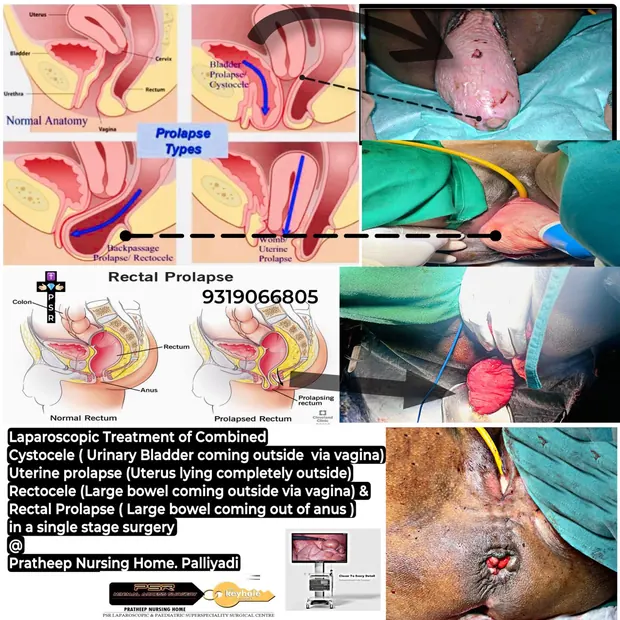 Clinical images relating to treatment of pelvic organ prolapse